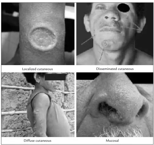 FIGURE 2   Clinical classifications of tegumentary leishmaniasis.