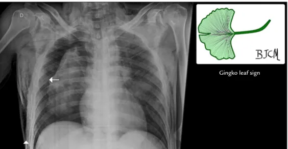 FIGURE 4   The pattern of pectoralis major muscle outlined by  the air.