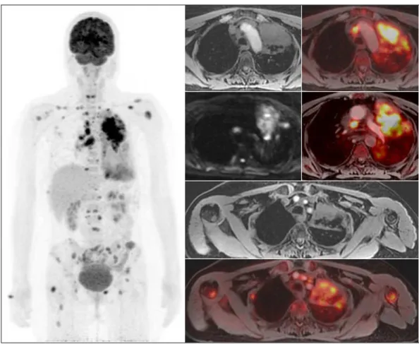 FIGURE 5   Coronal MIP PET and axial slices of T1-weighted PET/MRI sequences and diffusion