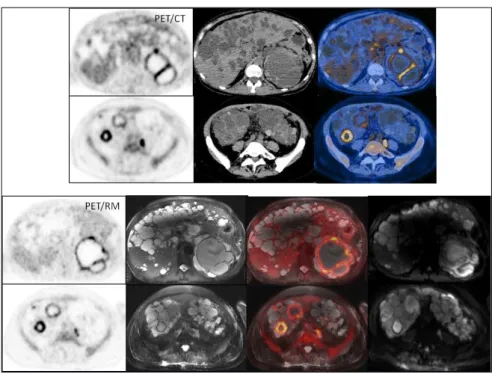 FIGURE 2   PET/CT (top) and PET/MRI (bottom) showing axial slices with T2-weighted sequences and diffusion