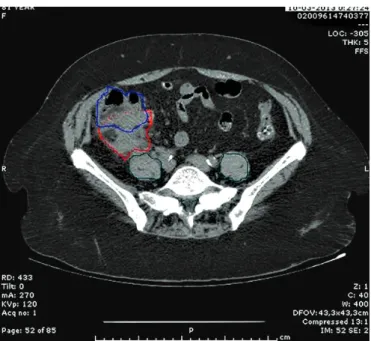 FIGURE 2:  A  computed  tomography  (CT)  scan  with  an  intra-abdominal  mass.