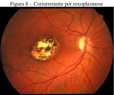 Figura 8 – Coriorretinite por toxoplasmose 