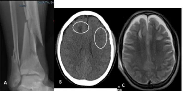 Figure 1 - Images of patient 1 at admission to the emergency room. (A) Multi- Multi-fragmentary fractures of the lower third of right tibia and fibula