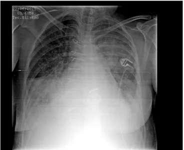 Figure 2 - Chest X-ray revealing improvement of the radiological picture after  endobronchial thrombolysis.