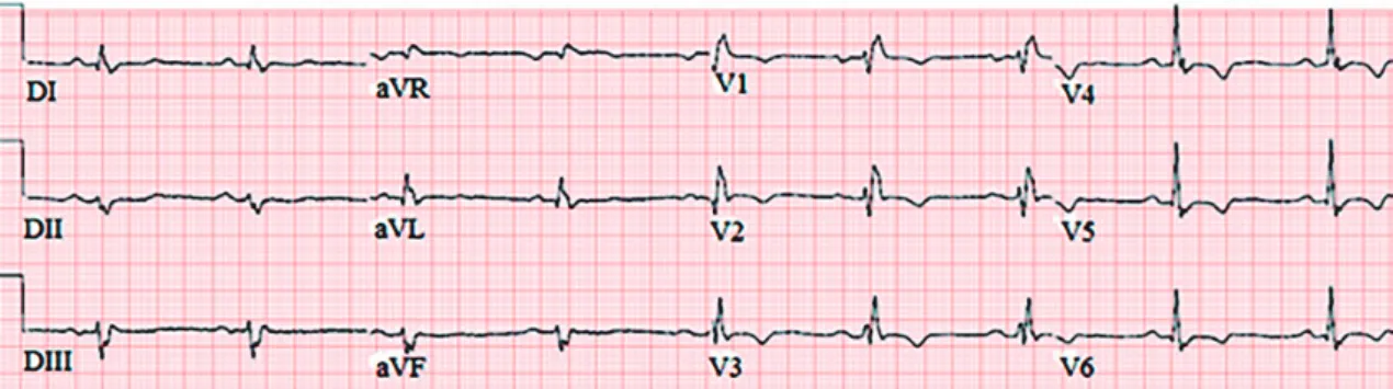 FIGURE 1: An electrocardiogram showing the typical features of Chagas cardiomyopathy. It displays right bundle branch block  associated with left anterior hemiblock