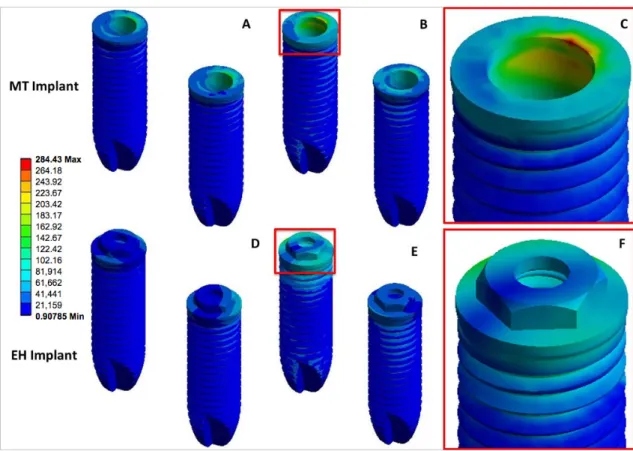 Figure 1. Qualitative analysis of the minimum principal stress for bone (compression stress = negative values)