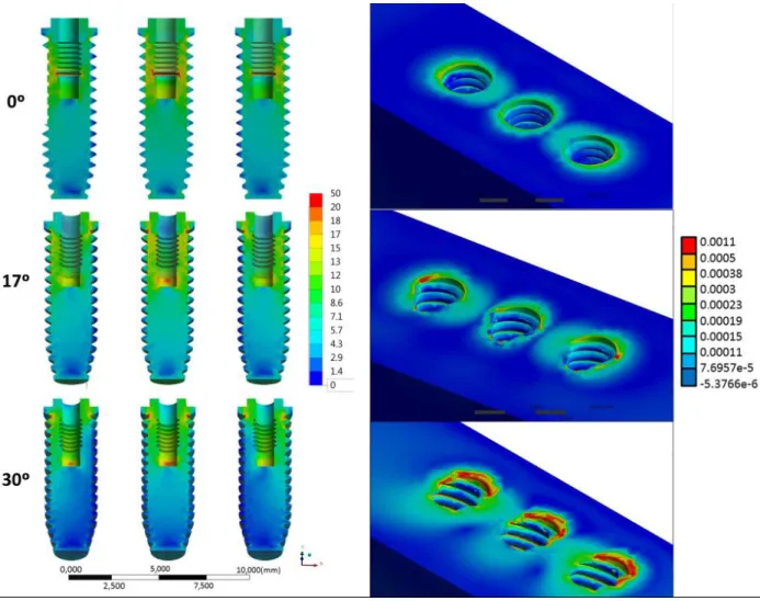 Figure 3. Von Mises Stress for the implant’s threads in sagittal vision and Microstrain generated in peri-implant tissue for all groups.