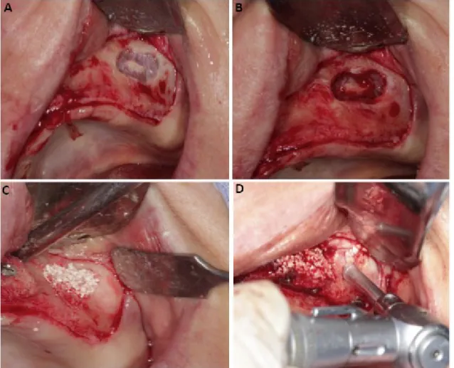 Figure 1. Exposure (A) and elevation (B) of the sinus membrane, insertion of the biomaterial (C)