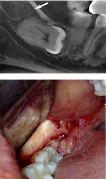 Figure 2. Tomographic and clinical images of an accessory bifid  retromolar canal (Class D) in very close proximity to an unerupted  horizontal third molar, which was surgically extracted (clinical image  consented).