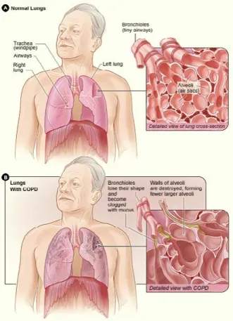 FIGURE 2. Sarcoidosis. From USA National Heart, Lung, and  Blood Institute:  Lung Diseases: Sarcoidosis: Signs &amp; Symptoms