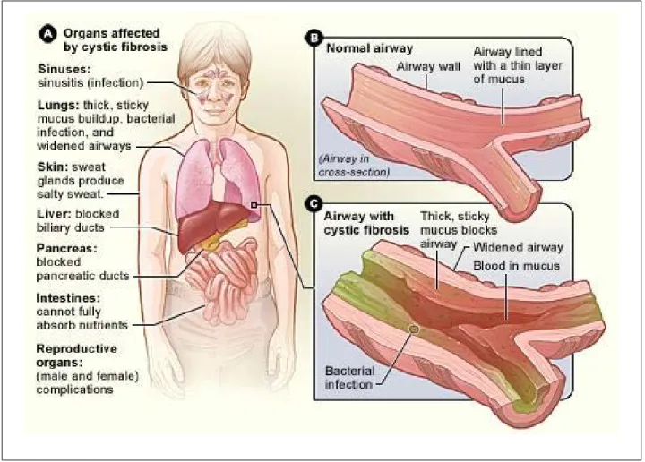 FIGURE 4. Cystic fibrosis. From USA National Heart Lung and Blood Institute.  https://www.nhlbi.nih.gov/health-topics/