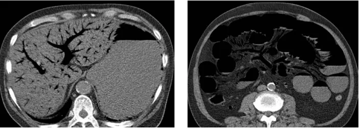 FIG. 1. A 59-YEAR-OLD MALE WHO PRESENTED ACUTE ABDOMINAL PAIN.