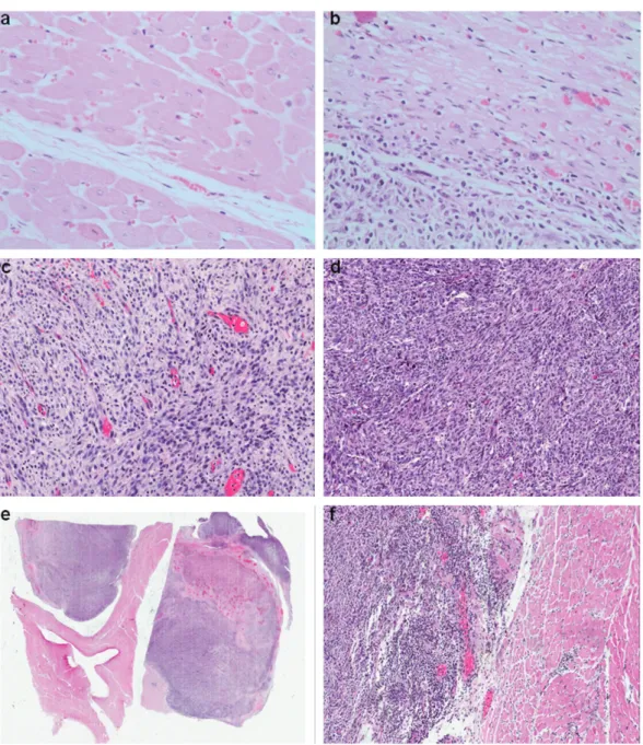 Figure 1. Comparative photomicroscopy of the histological differences between tissues show progression and differentiation of tumor from skeletal muscle  and aspects of heart metastasis