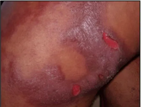 FIGURA 2: Reação reversa ulcerada  ±  Placa eritematoedematosa com áreas de ulceração