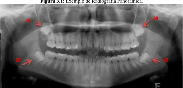 Figura 3.1: Exemplo de Radiografia Panorâmica. 