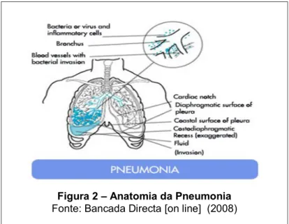 Figura 2  –  Anatomia da Pneumonia  Fonte: Bancada Directa [on line]  (2008) 