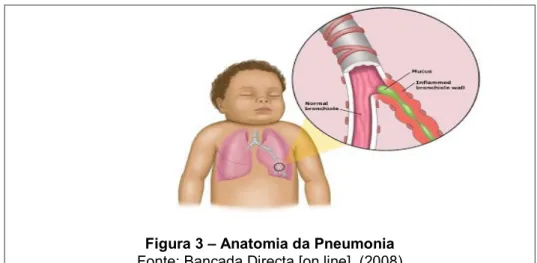 Figura 3  –  Anatomia da Pneumonia  Fonte: Bancada Directa [on line]  (2008)