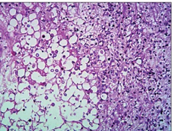 Figure 3. Histopathological analysis on the lesion. On the  left side, the deeper part of the lesion shows multiple fungi