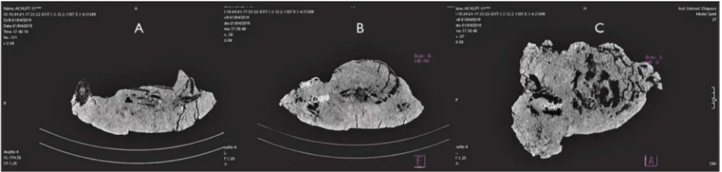 Figura 8. Bloco contendo o crânio retirado do fundo do recipiente cerâmico: A) crânio; B) crânio visto pela base; C) crânio visto pela norma  lateral esquerda