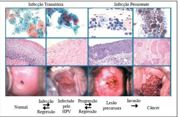 Figura 10 - Alterações do epitélio cervical e lâminas citológicas das lesões cervicais 