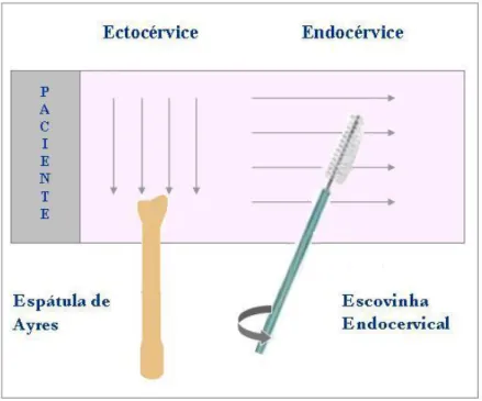 Figura 5  –  Distribuição na lâmina dos materiais coletados da ectocércive e endocérvice