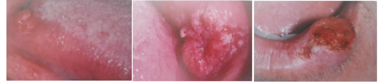 Figura 3 – Carcinoma de células escamosas - lesões (da esquerda para a direita) de língua, mucosa  jugal e lábio 