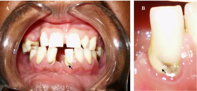 Figura  02    –    a)  Aspecto    clínico    compatível    com    placa    bacteriana    no    elemento  dentário; b) Aumento da imagem do elemento dentário 31