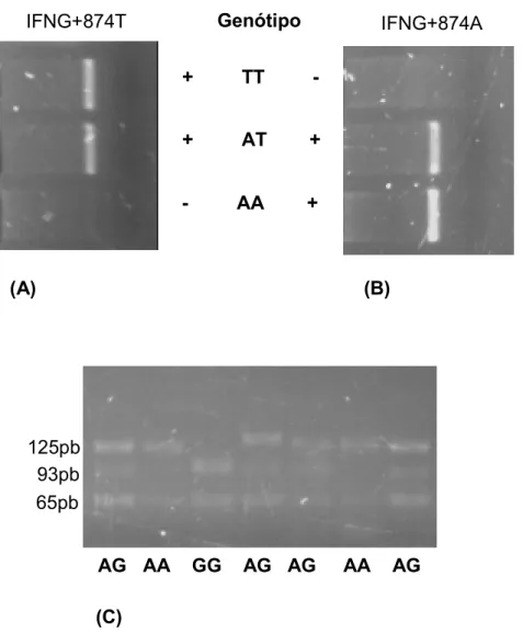 Figura 2: Genotipagem dos polimorfismos nos genes do IFN γ (IFNG+874T) e da IL 10 (IL10 1082)