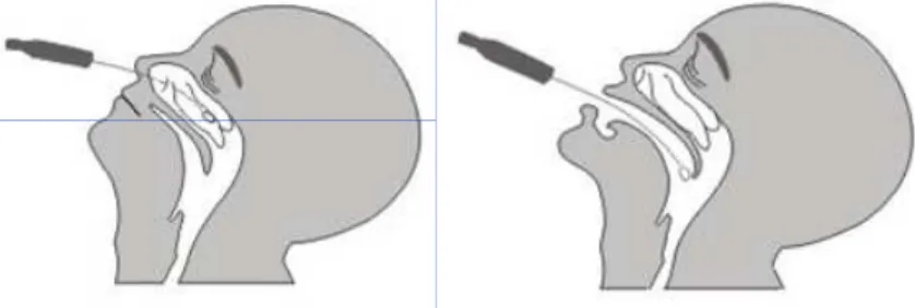 FIGURA 6. Desenho ilustrativo da coleta dos swabs nasal e da orofaringe 