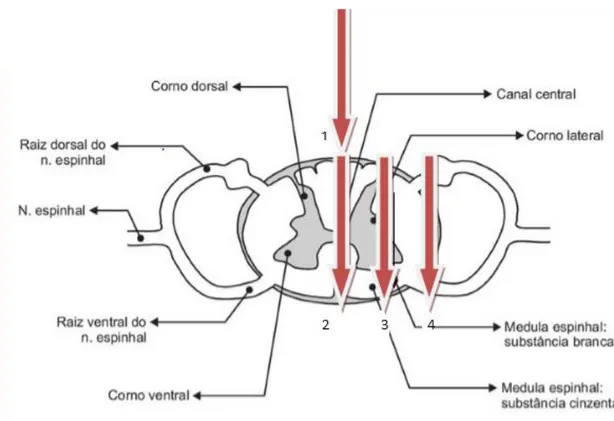 Figura 8: Ilustração Esquemática da Hemissecção Medular. As setas mostram o a lesão  parcial da medula espinhal realizada com o bisturi