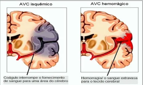 Figura 5: Tipos de AVC: isquêmico ou hemorrágico.                       