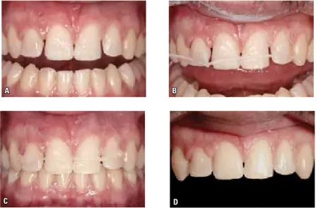 FIGURA 3 - Reabertura de espaço à mesial dos incisivos laterais superiores, após a fratura da colagem da contenção fixa superior ( A )