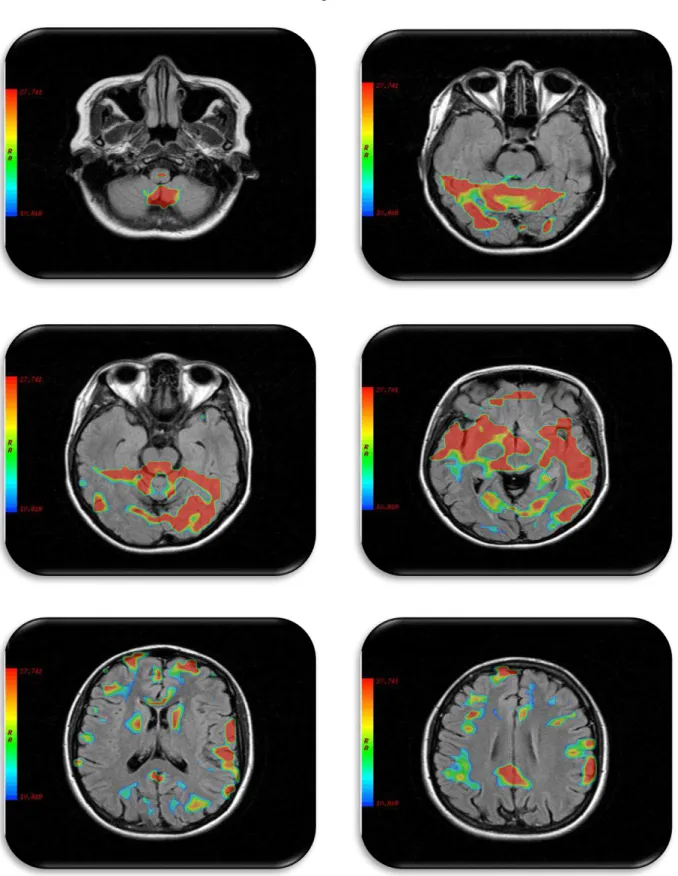 Figura 4: Imagens axiais de RMf, orientada segundo plano canto-meatal, correspondente às  áreas  ativadas:  Bulbo  ou  medula  oblonga,  cerebelo,  amigdala,  ponte,  tronco  cerebral  (mesencéfalo) lobo occipital (informação visual), lobo temporal (gerenc