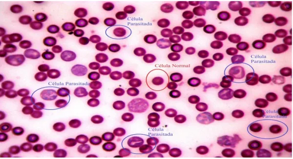 Figura  6:  Extensão  sanguínea  de  camundongo  BALB/c  infectado  com  P.  berghei.  Em  destaque podem ser observadas células normais e parasitadas