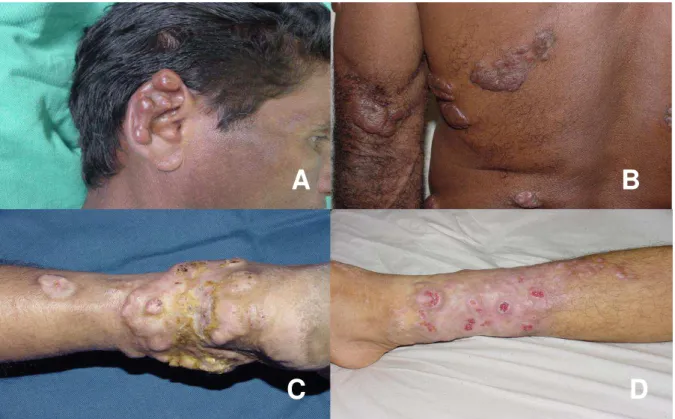 Figura  7.  Aspectos  clínicos  das  lesões  da  doença  de  Jorge  Lobo.  Lesões  de  aspecto  nodular, queloidiformes, no pavilhão auricular direito (A)