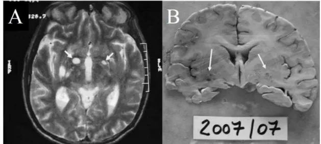 Figura 2.  Achados anatômicos  cerebrais causados pela meningite criptocócica.  A. Ressonância  magnética mostrando múltiplas pequenas lesões hiperintensas nos núcleos da base, nos núcleos  do tálamo e na substância branca (setas)