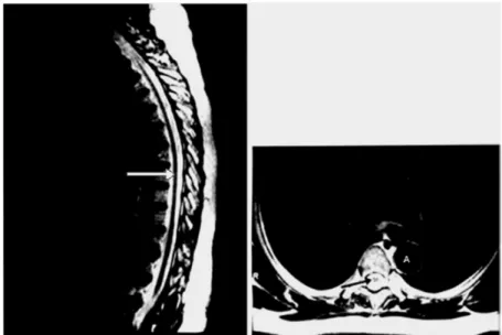 Figura  07  –  Ressonância  nuclear  magnética  da  coluna  vertebral.  Nos  cortes  sagital  e  axial  (imagem  ponderada  em  T2)  observa-se  a  atrofia  da  medula  espinhal  (setas)  que  encontra-se  rodeada  pelo  líquido  cefalorraquidiano  (em  br