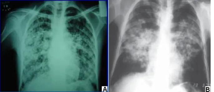 Figura  6  –  Forma  crônica  da  paracoccidioidomicose.  Radiologia  convencional  mostrando  imagens: A) opacidade difusa; B) padrão de lesão em “asa de borboleta”