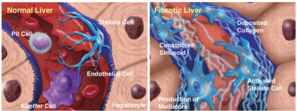 Figura 7 - Demonstrações ilustrativa do fígado normal e fígado com fibrose Fonte: Kawada, 2011