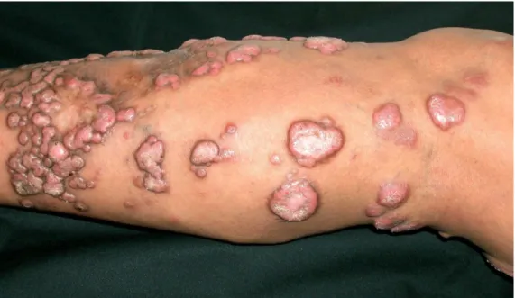 Figura 5: Doença de Jorge Lobo, lesão queloidiana  Cortesia do Prof. Dr. Arival de Brito 