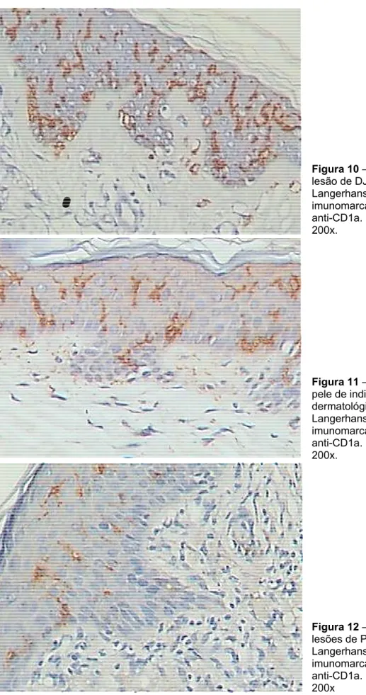 Figura 10  lesão de D Langerhan imunomarc anti-CD1a 200x.  Figura 11  pele de ind dermatológ Langerhan imunomarc anti-CD1a 200x