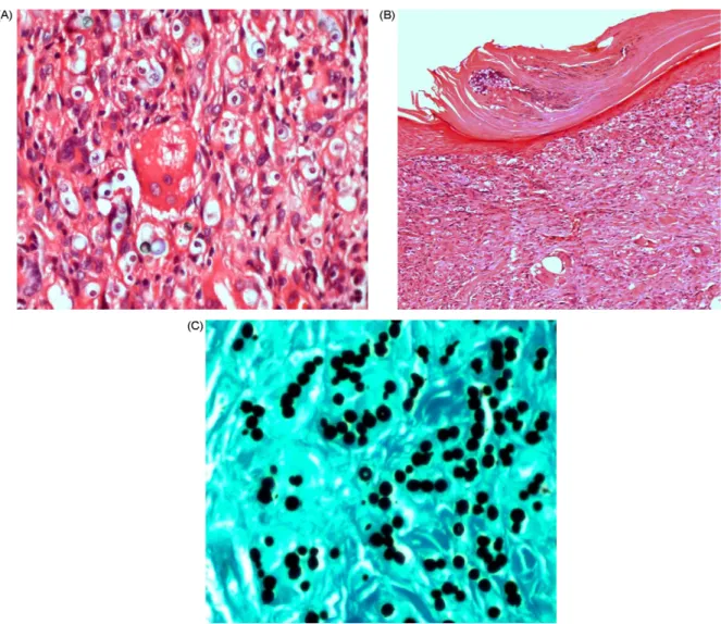Fig. 1. Jorge Lobo’s disease—Histopathological aspects shown inflammatory infiltrate of the dermis consisted of histiocytes, epithelioid cells, giant cells with parasitic corpuscles (A) frequently associated with asteroid corpuscles
