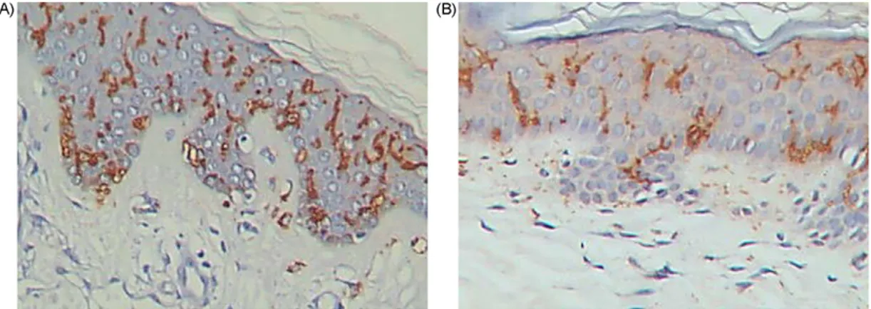 Fig. 3. Jorge Lobo’s disease—Immunonistochesmistry for Langerhans cells with anti-CD1a antibody shown positive cells in Jorge Lobo’s disease (A) and normal skin (B)