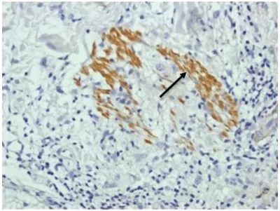 Figura 8: Imunoistoquímica positiva para IL-22 na forma TT (seta).  