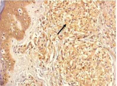 Figura 8: Imunoistoquímica positiva para IL-13 na forma VV (seta). 