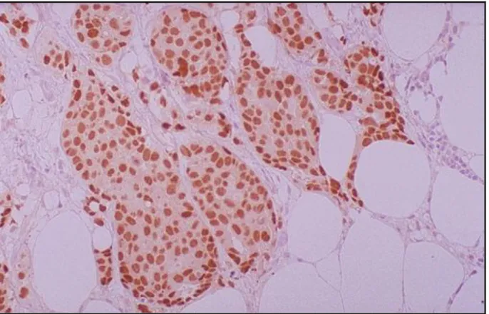 FIGURA 10  –  Corte Histológico de Tumor Mamário com Receptor de Estrogênio Positivo. 