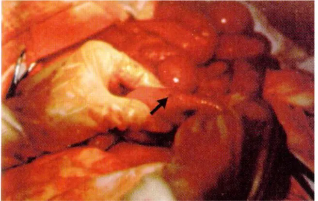 Figura 3  –  Perfuração em alça intestinal (seta) causada pela Salmonella Typhi  Fonte: PARRY et al., 2002