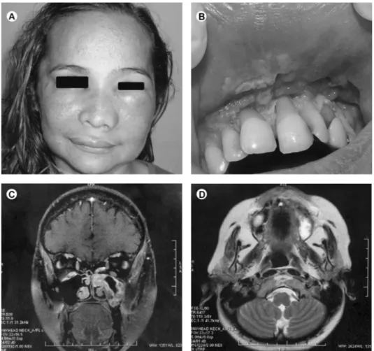 Figure 1. A: Erythematous facial asymmetry with elevation of the nasal wing and inferior eyelid