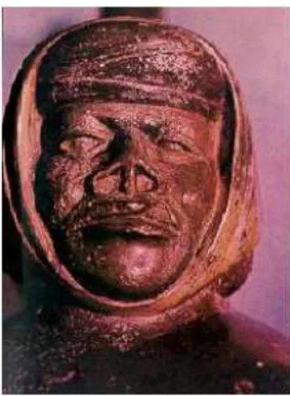 Figura  1  -  Cerâmica  pré-Inca  indicando  lesões  causadoras  de  deformações  cutâneas  na  face  em  caso de leishmaniose
