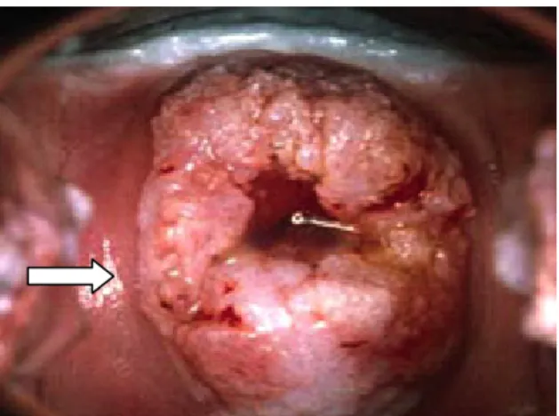 Figura 1: Foto de colposcopia realizada em paciente portadora de lesão neoplásica em  colo de útero apresentando sangramento (seta).